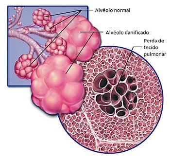 Ilustração comparando alvéolos pulmonares normais e alvéolos danificados por enfisema